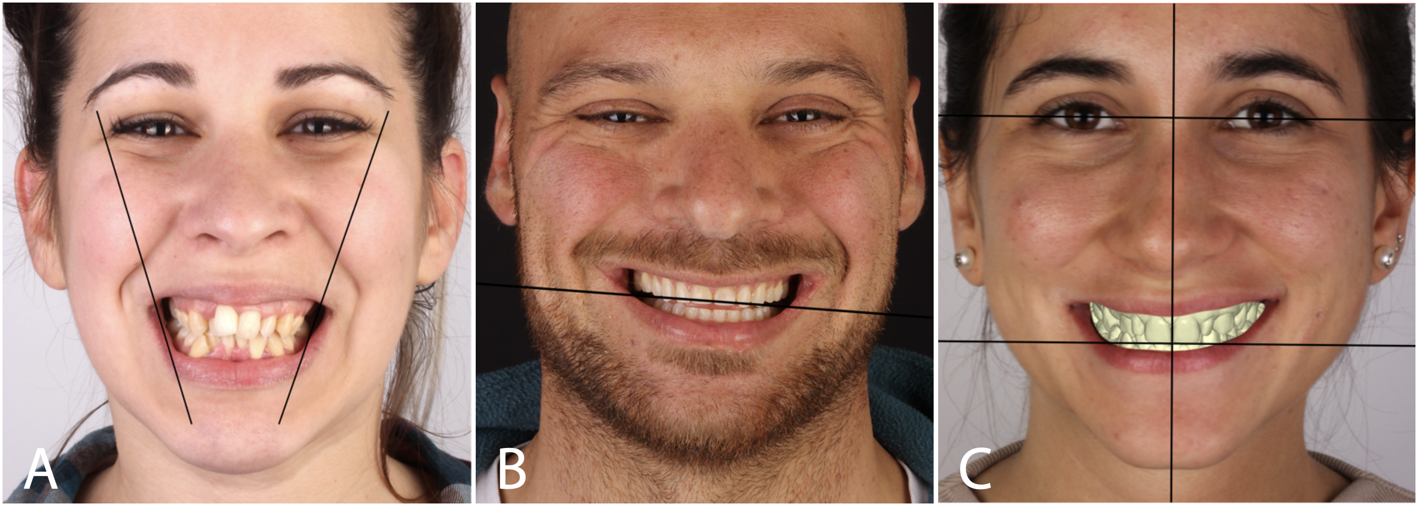 Figure 6 – The three keys of step 6 – Transverse dimension of the maxilla (A), transverse angulation of the occlusal plane (B) and symmetry of the midlines (C). Figure 6 – The three keys of step 6 – Transverse dimension of the maxilla (A), transverse angulation of the occlusal plane (B) and symmetry of the midlines (C).