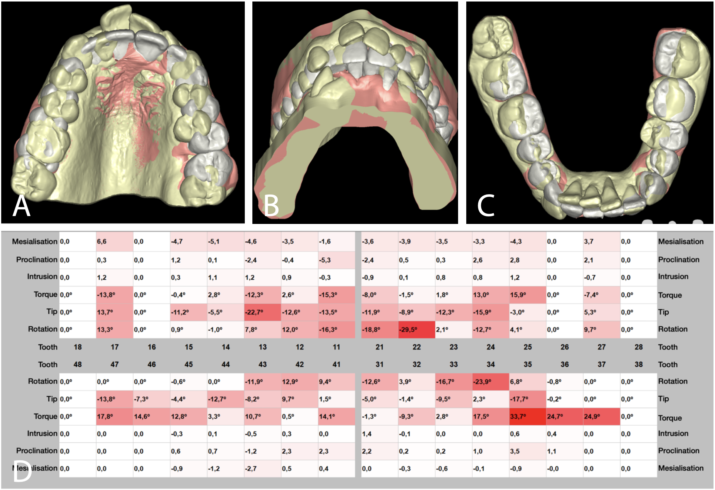 Figure 7 – (A-C) Visualisation of tooth movements using superimposition of STL scans. (D) An example table of values displaying the desired movements of each tooth in a patient. Figure 7 – (A-C) Visualisation of tooth movements using superimposition of STL scans. (D) An example table of values displaying the desired movements of each tooth in a patient.