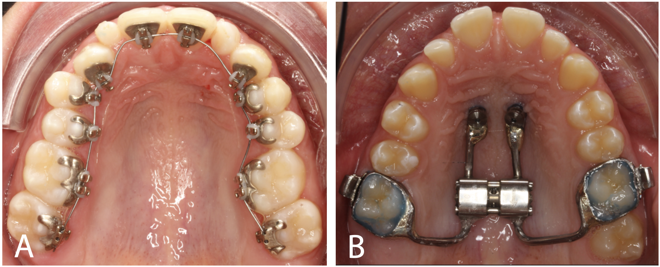 Figure 8 – Example of two techniques that can be used to reach treatment objectives. (A) Incognito bracket system. (B) A MARPE (miniscrew assisted rapid palatal expansion) hybrid expander. Figure 8 – Example of two techniques that can be used to reach treatment objectives. (A) Incognito bracket system. (B) A MARPE (miniscrew assisted rapid palatal expansion) hybrid expander.