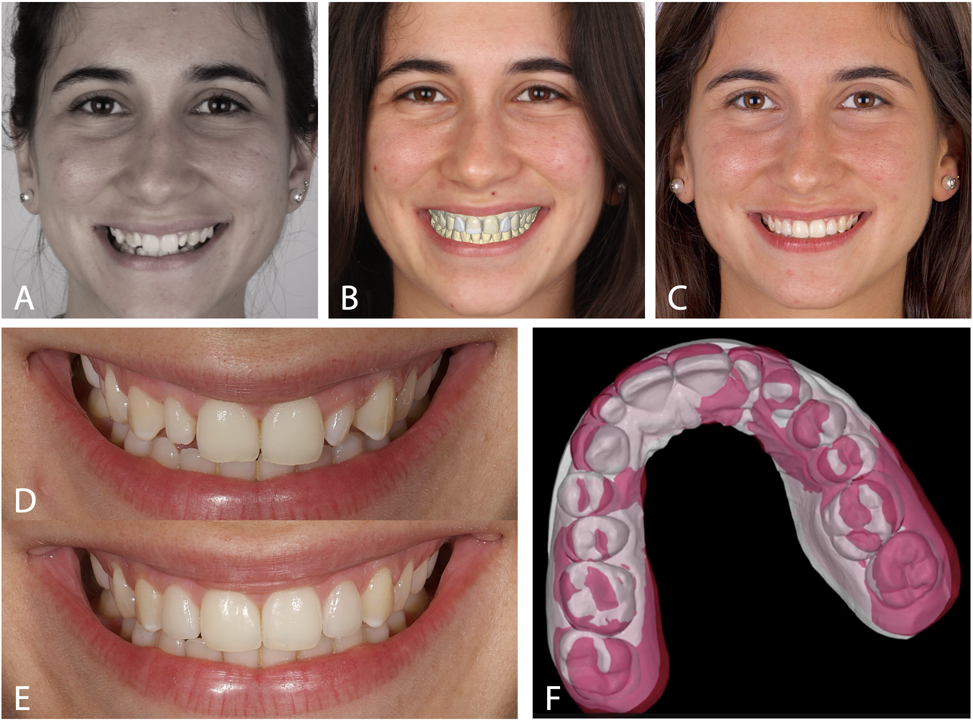 Figure 9 – Verification of treatment results in a patient using different methods. (A-C) Facial photographs showing the patient before treatment (A), a virtual mock-up during treatment (B) and post-treatment (C). (D,E) Intraoral photographs of the patient before treatment (D) and post-treatment (E). (F) Superimposition of pre- and post-treatment digital impression STL files. Pre-treatment is in white and post-treatment is in pink. All the above records are from the same patient. Figure 9 – Verification of treatment results in a patient using different methods. (A-C) Facial photographs showing the patient before treatment (A), a virtual mock-up during treatment (B) and post-treatment (C). (D,E) Intraoral photographs of the patient before treatment (D) and post-treatment (E). (F) Superimposition of pre- and post-treatment digital impression STL files. Pre-treatment is in white and post-treatment is in pink. All the above records are from the same patient.