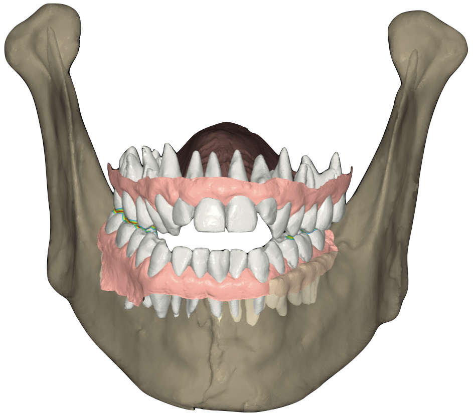 Figure 3 – Anatomical virtual articulator of a patient including the true hinge axis. This is facilitated through the superimposition of a DICOM provided by a CBCT and the STLs provided by an intraoral scanner. Figure 3 – Anatomical virtual articulator of a patient including the true hinge axis. This is facilitated through the superimposition of a DICOM provided by a CBCT and the STLs provided by an intraoral scanner.