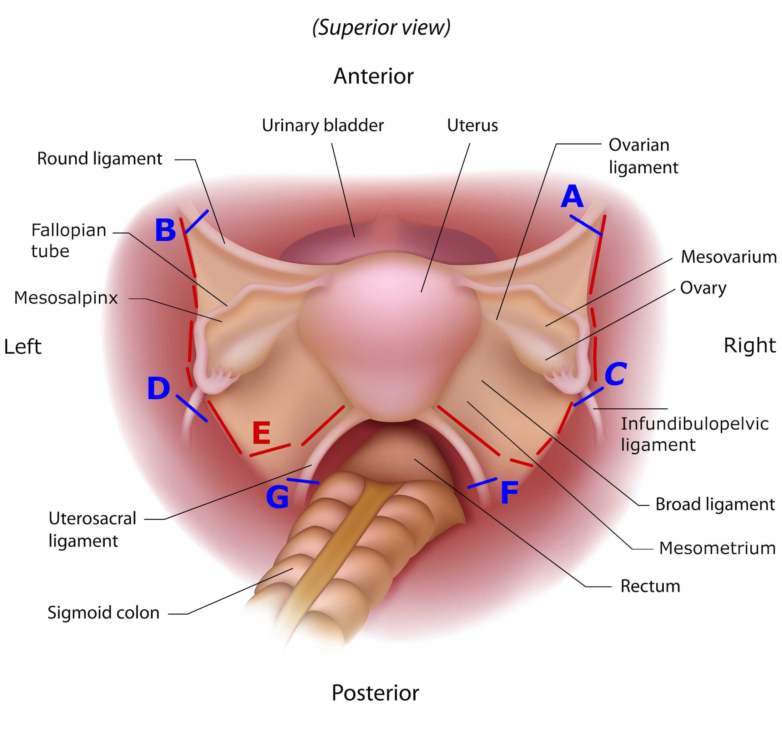 Figure 1. Female Reproductive System. (modified from original image by Alila Medical Media). Visual depiction of the anatomic landmarks divided during en bloc recovery of the female reproductive system (FRS) from a brain-dead donor. The FRS is comprised of the ovaries, Fallopian tubes and uterus which is covered by visceral peritoneum (i.e., the broad ligament) and supported in the pelvis by fibrous and/or vascular structures (i.e. the round, infundibulopelvic, and uterosacral ligaments). Peritoneum and support structures must be sequentially divided in order to remove the FRS from the pelvis and maintain orientation of the organs comprising it. Figure 1. Female Reproductive System. (modified from original image by Alila Medical Media). Visual depiction of the anatomic landmarks divided during en bloc recovery of the female reproductive system (FRS) from a brain-dead donor. The FRS is comprised of the ovaries, Fallopian tubes and uterus which is covered by visceral peritoneum (i.e., the broad ligament) and supported in the pelvis by fibrous and/or vascular structures (i.e. the round, infundibulopelvic, and uterosacral ligaments). Peritoneum and support structures must be sequentially divided in order to remove the FRS from the pelvis and maintain orientation of the organs comprising it.