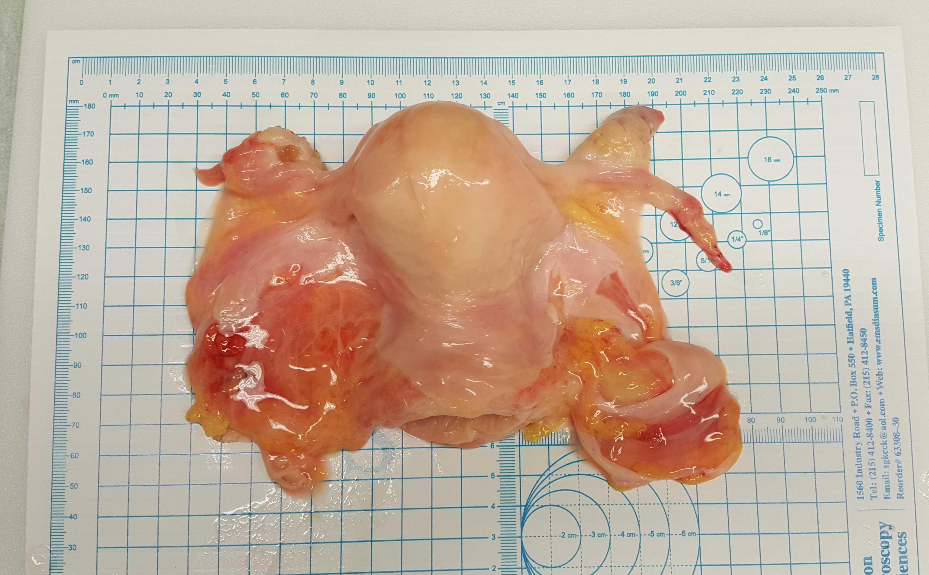 Figure 2. Measurement of Female Reproductive Organs. Width (shown) and length of the FRS en bloc is recorded transport of the specimen back to the laboratory prior to collection of organ and tissue samples. Width, length, height, and weight of Individual organ are collected as the ovaries, Fallopian tubes and uterus are isolated prior to tissue collection. Figure 2. Measurement of Female Reproductive Organs. Width (shown) and length of the FRS en bloc is recorded transport of the specimen back to the laboratory prior to collection of organ and tissue samples. Width, length, height, and weight of Individual organ are collected as the ovaries, Fallopian tubes and uterus are isolated prior to tissue collection.