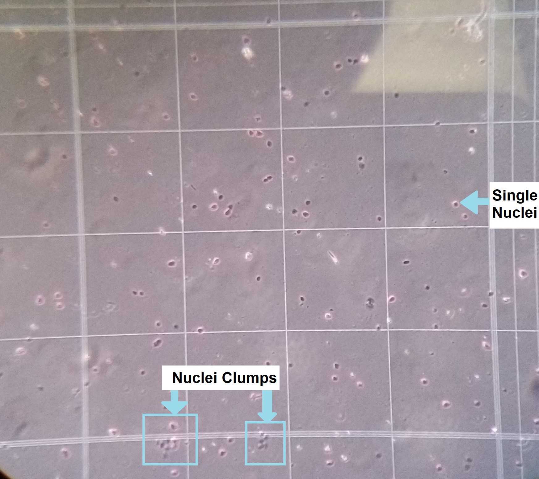 Figure 4. A 10x objective view of what a single nuclei versus a nuclei clump looks like on a hemocytometer. Figure 4. A 10x objective view of what a single nuclei versus a nuclei clump looks like on a hemocytometer.