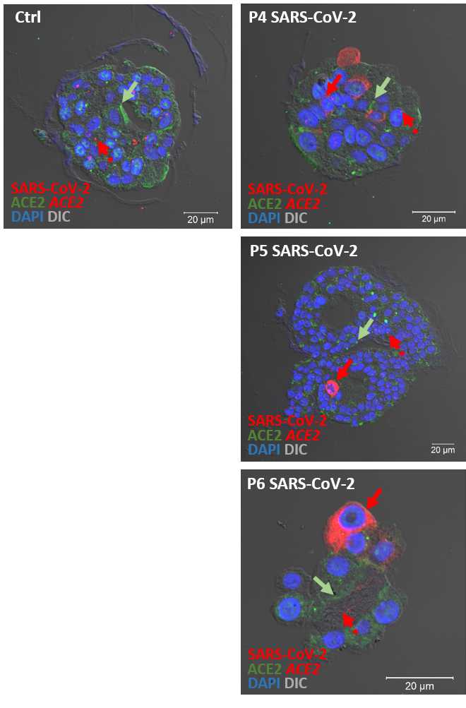 Representative immunostainings for exemplary mock- (left panel) and SARS-CoV-2-infected (right column) human alveolar-like organoids. Shown are immunostainings for SARS-CoV-2 (N-protein, red), ACE2 (green) and ACE2 mRNA expression (red dots, see in situ hybridization - step 55) 24 h post infection (MOI = 1). Arrows indicate either cells positive for SARS-CoV-2 (red arrows) or areas of particularly high ACE2 expression (protein: green arrows, mRNA: red dotted arrows). Cell nuclei are visualized by DAPI stain (blue). Scale bars = 20 µm. Representative immunostainings for exemplary mock- (left panel) and SARS-CoV-2-infected (right column) human alveolar-like organoids. Shown are immunostainings for SARS-CoV-2 (N-protein, red), ACE2 (green) and ACE2 mRNA expression (red dots, see in situ hybridization - step 55) 24 h post infection (MOI = 1). Arrows indicate either cells positive for SARS-CoV-2 (red arrows) or areas of particularly high ACE2 expression (protein: green arrows, mRNA: red dotted arrows). Cell nuclei are visualized by DAPI stain (blue). Scale bars = 20 µm.
