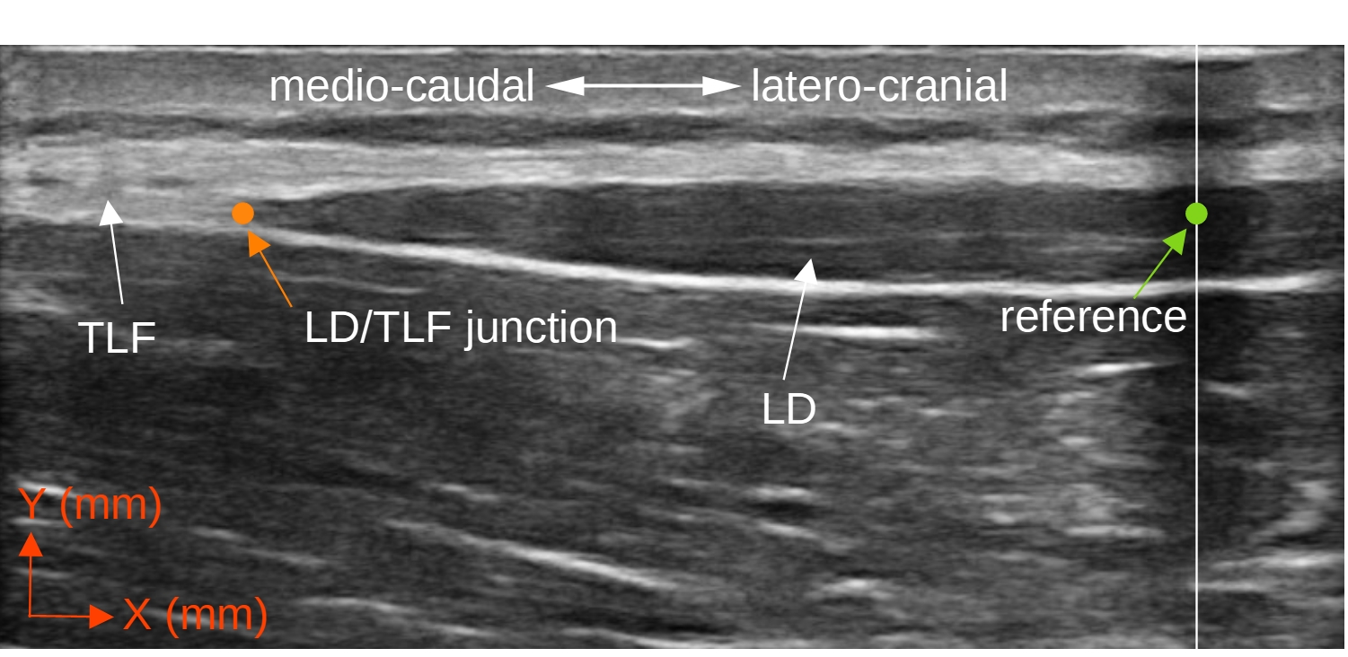 Figure 4. Single image measurement of TLF deformation. LD/TLF, junction of LD and TLF (orange dot); reference (green dot) at the middle of the artificial shadow; LD, latissimus dorsi muscle; TLF, thoracolumbar fascia. Figure 4. Single image measurement of TLF deformation. LD/TLF, junction of LD and TLF (orange dot); reference (green dot) at the middle of the artificial shadow; LD, latissimus dorsi muscle; TLF, thoracolumbar fascia.