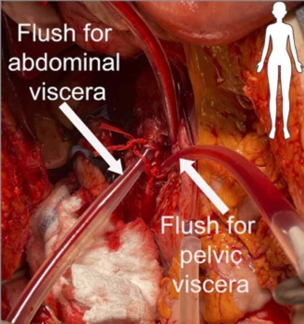 Preservation of the FRS during multiorgan procurement. Cannulation of the aorta must be modified in order to perfuse the FRS.Aortic arteriotomy is made 2-3cm above where the abdominal aorta bifurcates into the left and right common iliac arteries. Standard 24-gauge cannula is inserted into the aortic arteriotomy, directed cephalad and secured with a Dacron tie to perfuse the abdominal viscera. An 18-gauge cannula is inserted through the same aortic arteriotomy, directed caudad and secured to perfuse the pelvic viscera. Preservation of the FRS during multiorgan procurement. Cannulation of the aorta must be modified in order to perfuse the FRS.Aortic arteriotomy is made 2-3cm above where the abdominal aorta bifurcates into the left and right common iliac arteries. Standard 24-gauge cannula is inserted into the aortic arteriotomy, directed cephalad and secured with a Dacron tie to perfuse the abdominal viscera. An 18-gauge cannula is inserted through the same aortic arteriotomy, directed caudad and secured to perfuse the pelvic viscera.