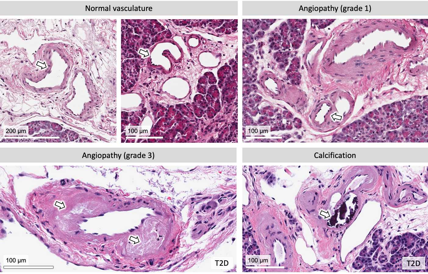 Figure 7. Normal and pathologic vascular architecture. Figure 7. Normal and pathologic vascular architecture.