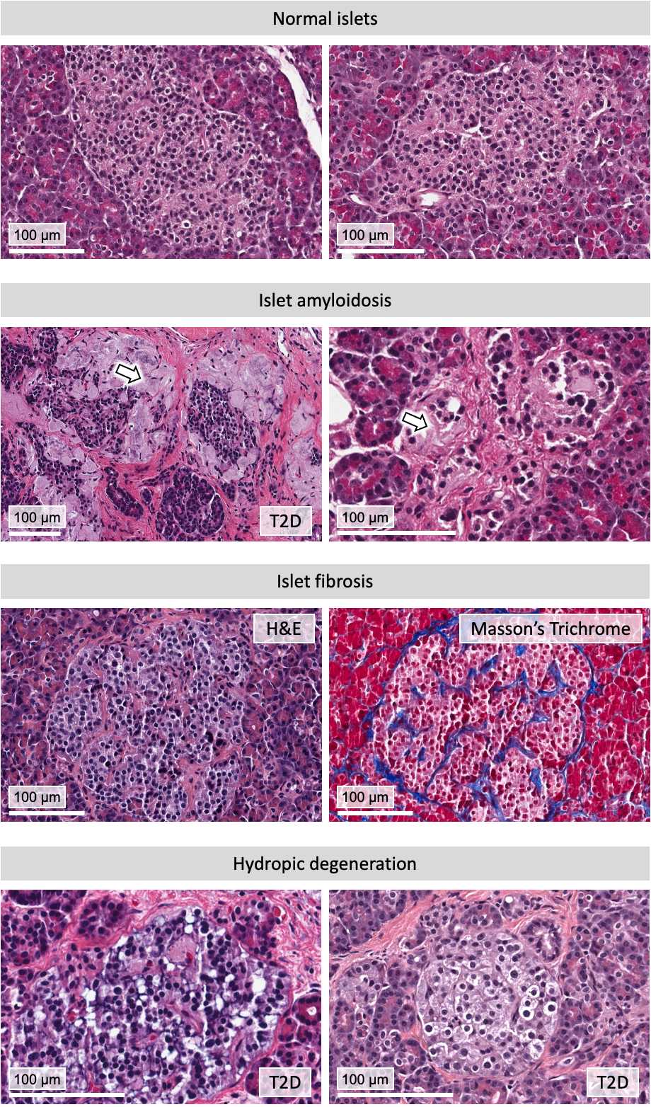Figure 1. Examples of endocrine pancreas features. For islet fibrosis, H&E stain is shown on the left, while an adjacent section was stained using Trichrome to confirm fibrosis. Figure 1. Examples of endocrine pancreas features. For islet fibrosis, H&E stain is shown on the left, while an adjacent section was stained using Trichrome to confirm fibrosis.