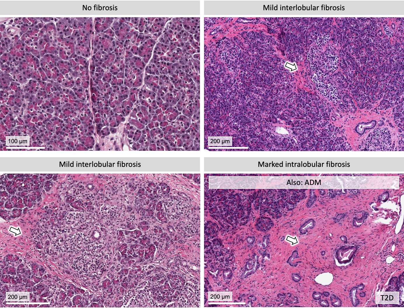 Figure 3. Examples of fibrotic patterns in exocrine pancreas. Note that fibrosis can be intra- or interlobular or may occur around ducts or vasculature. Figure 3. Examples of fibrotic patterns in exocrine pancreas. Note that fibrosis can be intra- or interlobular or may occur around ducts or vasculature.