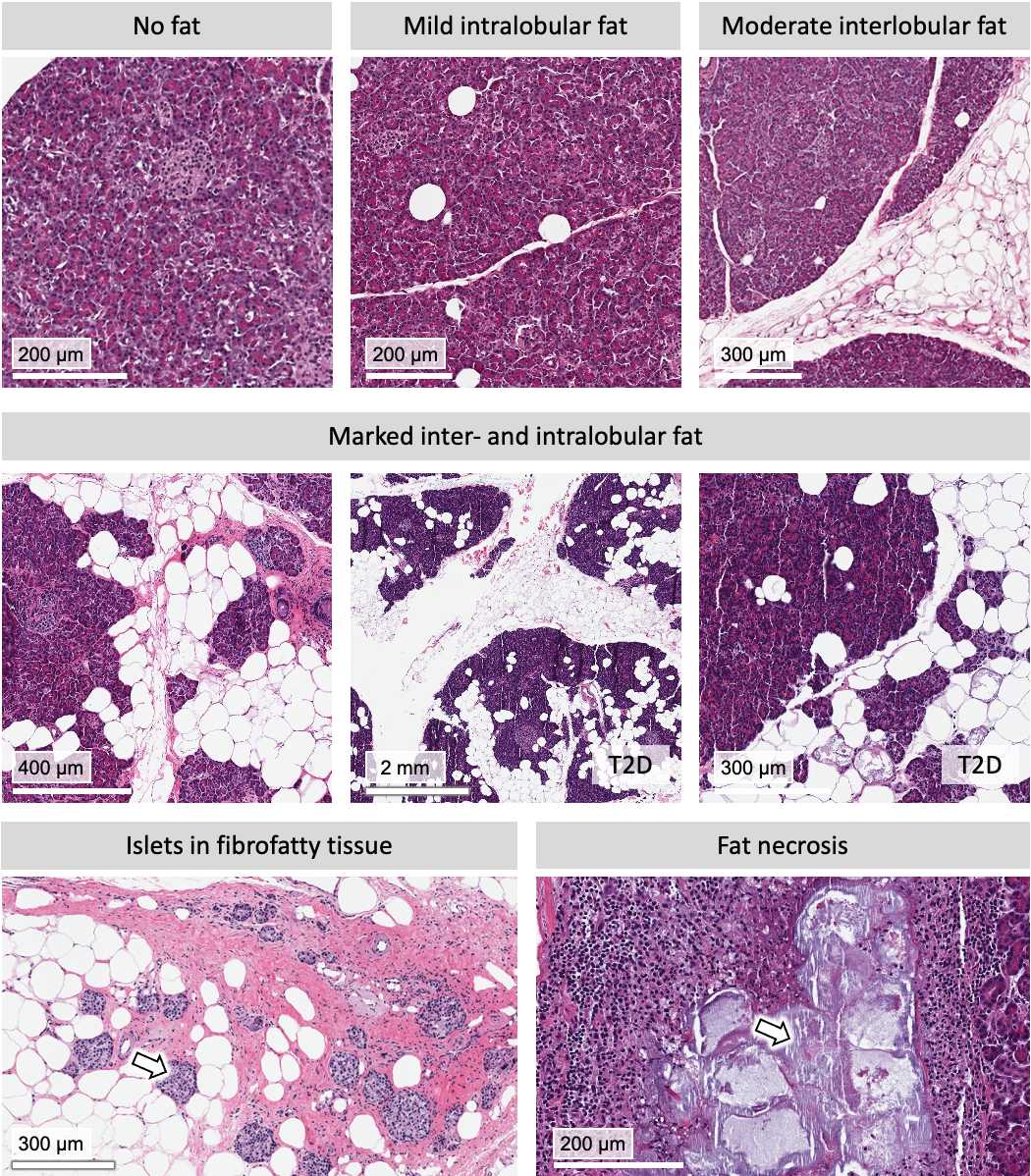 Figure 4. Examples of fat infiltration in nondiabetic and T2D pancreas. Figure 4. Examples of fat infiltration in nondiabetic and T2D pancreas.