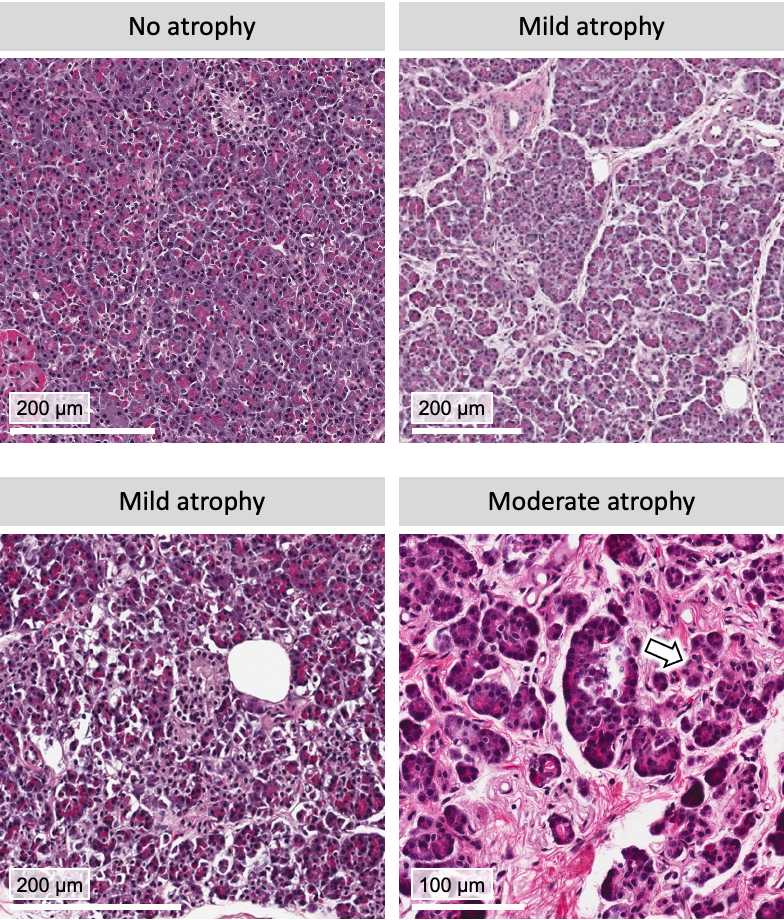 Figure 5. Examples of acinar atrophy. Figure 5. Examples of acinar atrophy.