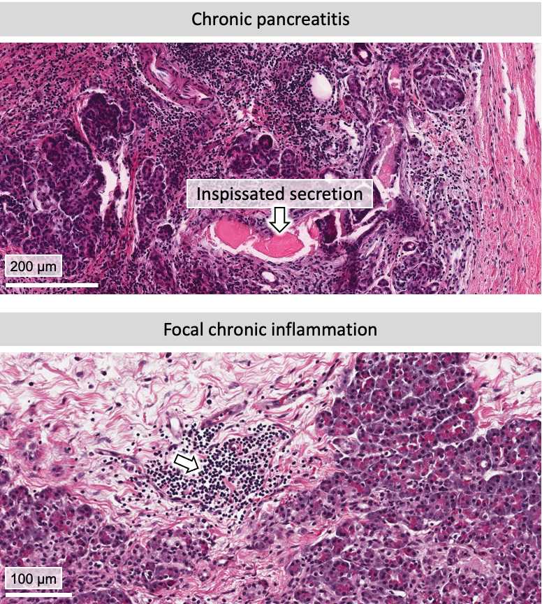 Figure 2. Examples of exocrine pancreas inflammation and pancreatitis. Figure 2. Examples of exocrine pancreas inflammation and pancreatitis.